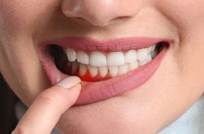 Causes-Prevention of Pyorrhoea: जानिए पायरिया के कारण, लक्षण और उपचार...