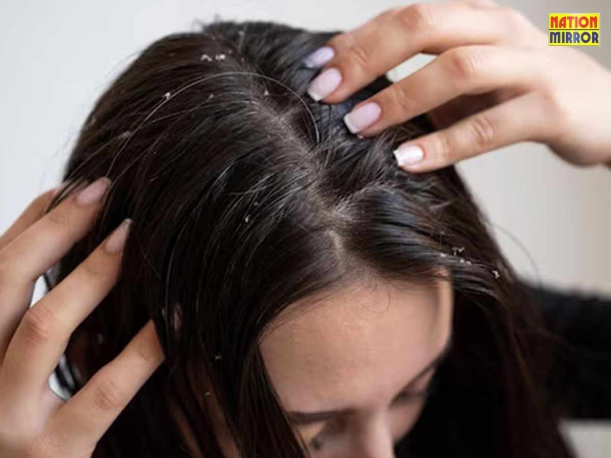 Dandruff and Itchy Scalp Treatment: सिर में डैंड्रफ या खुजली हो तो क्या करें? जानिए कारण और इलाज...