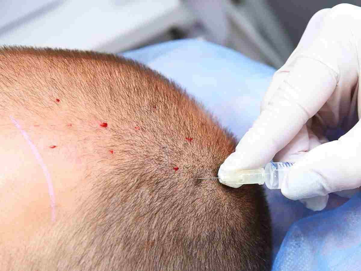 Engineer Dies During Hair Transplant: पति बोला सरप्राइज दूंगा, हेयर ट्रांसप्लांट के दौरान इंजीनियर की मौत!
