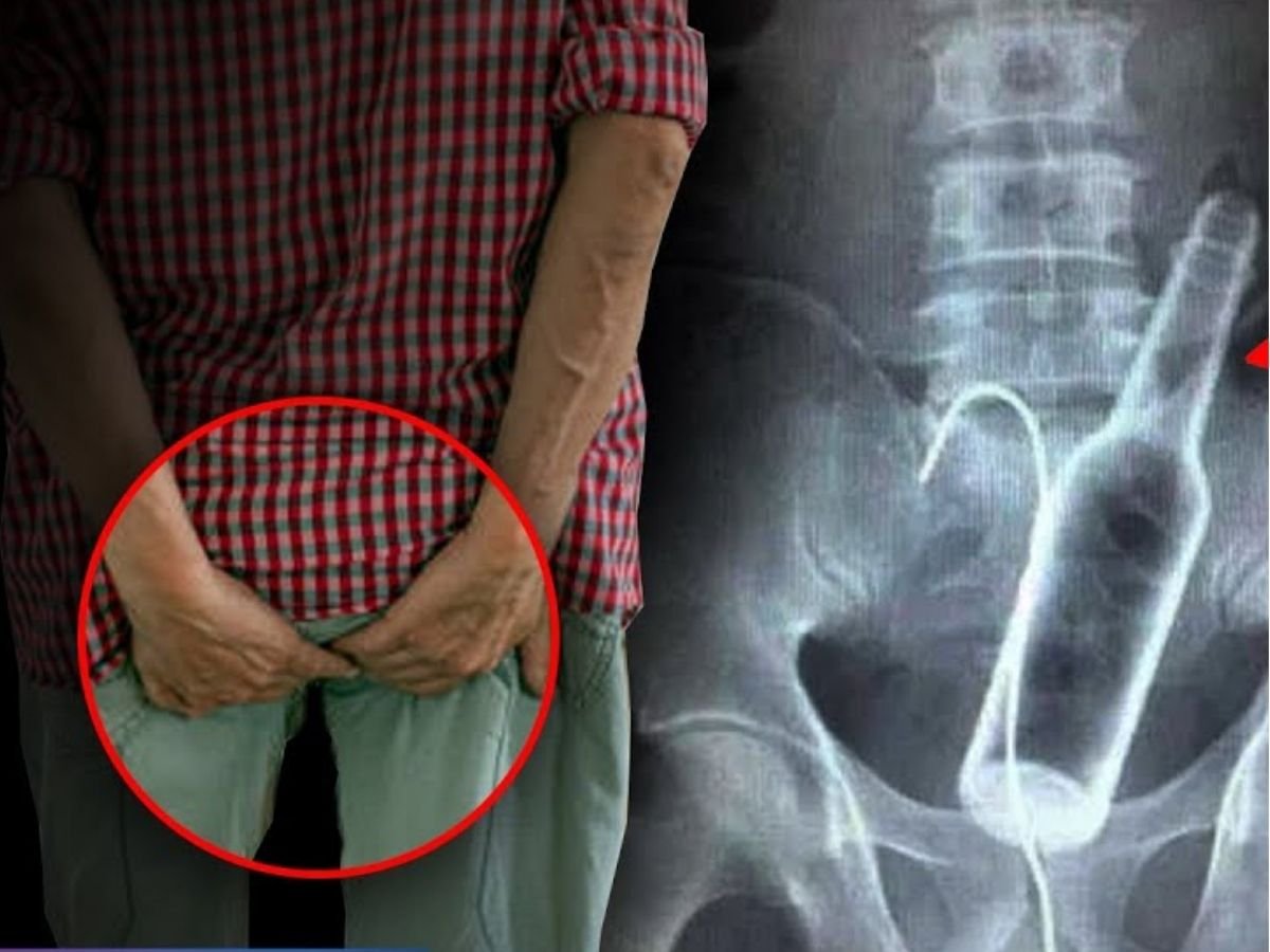 Pleasure पाने के लिए युवक ने मलद्वार में घुसाई बोतल