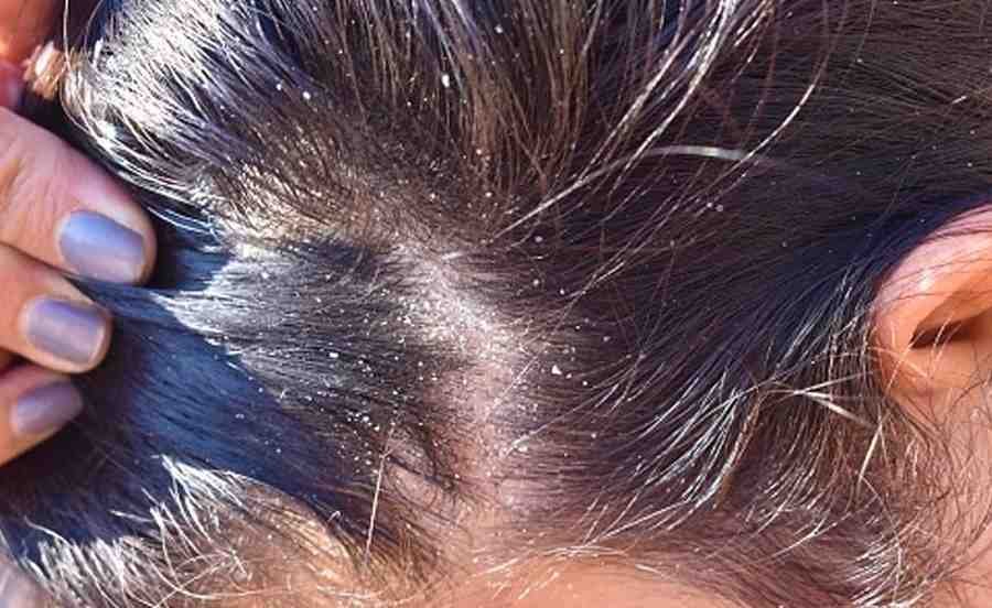 Winter Dandruff : सर्दियों में डैंड्रफ क्यों बढ़ जाता है ?