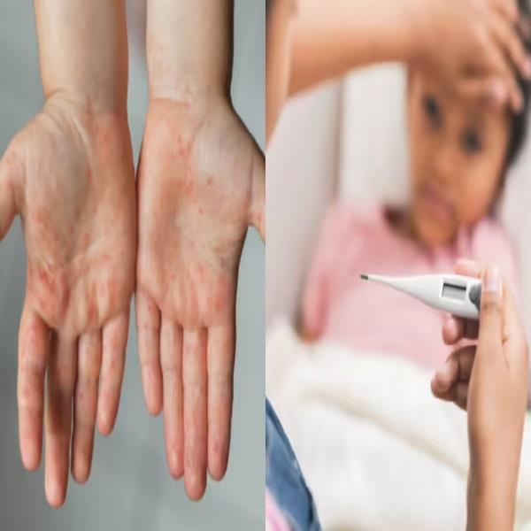 क्या है टोमेटो फीवर, कैसे फैलता है, बच्चों के लिए क्यों खतरनाक?
