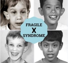 fragile x syndrome एक अनदेखा लेकिन गंभीर आनुवंशिक विकार जानिए लक्षण और समाधान
