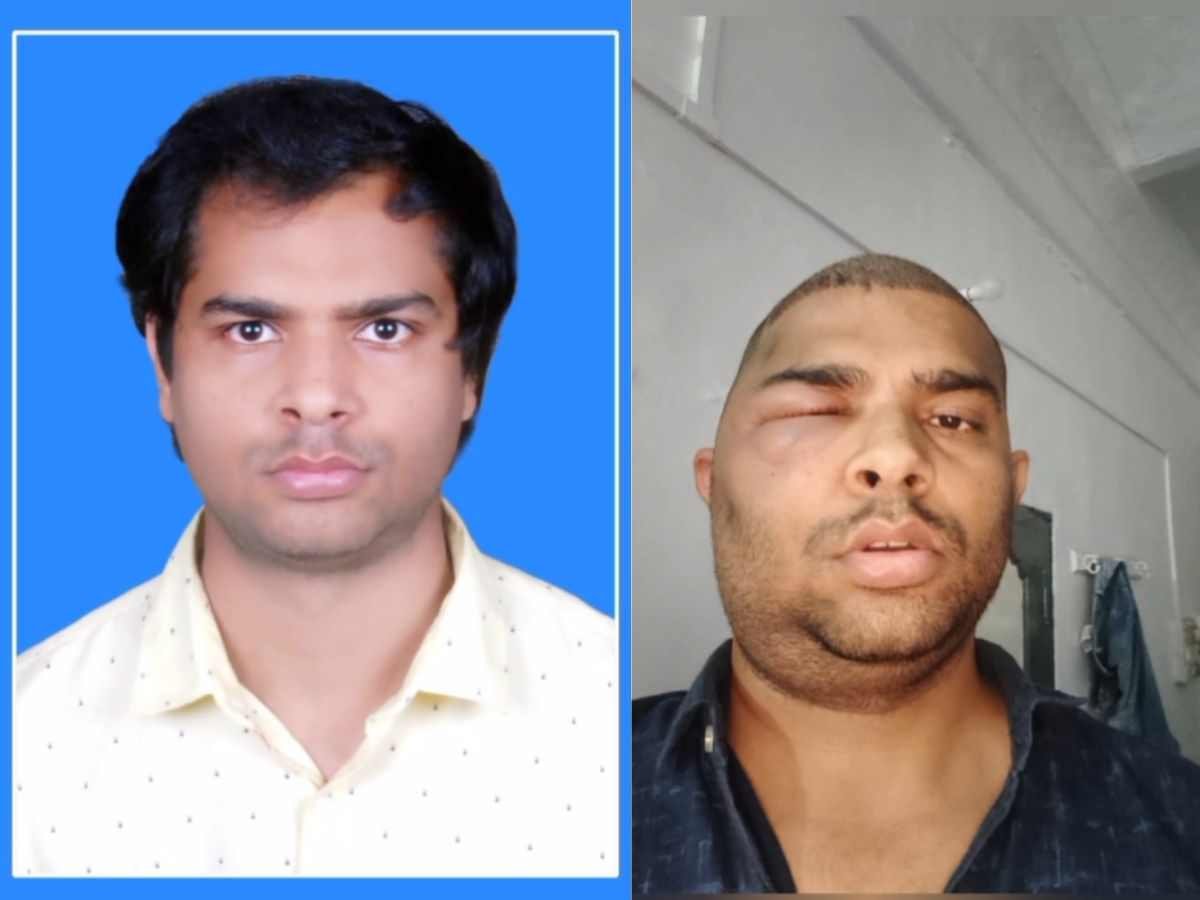 kanpur hair transplant case हेयर ट्रांसप्लांट के बाद इंजीनियर की मौत डॉक्टर अनुष्का तिवारी पर लापरवाही के गंभीर आरोप