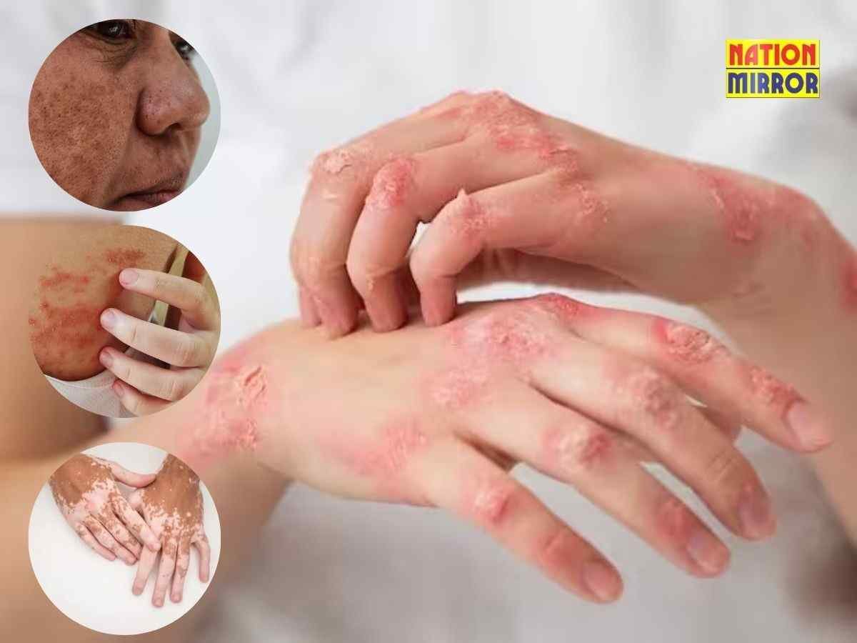 skin diseases causes क्या त्वचा रोग आनुवंशिक हैं या लापरवाही का नतीजा
