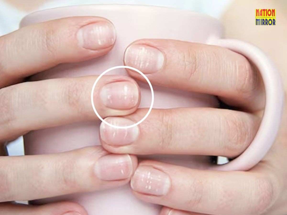 white spots on nails क्या किसी बीमारी का संकेत या आम समस्या