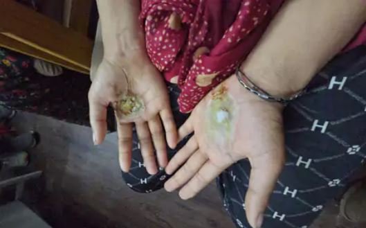 ujjain अंधविश्वास का कहर चुड़ैल बताकर महिला की हथेलियां जलाईं गर्म सिक्के से सिर दागा 8 पर fir