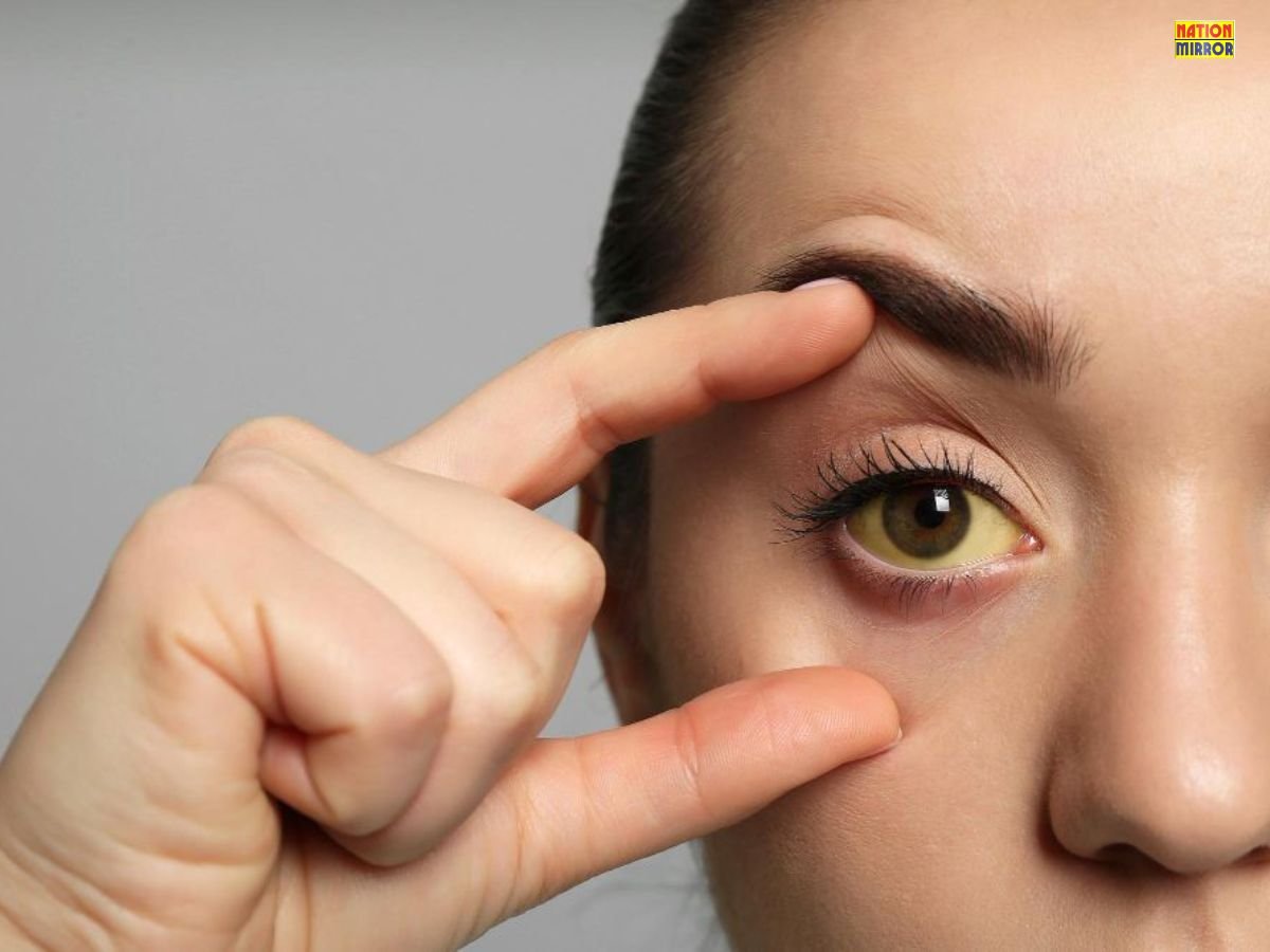 Black Jaundice Symptoms: लिवर पर हमला करने वाली खतरनाक बीमारी! जानिए लक्षण और बचाव...