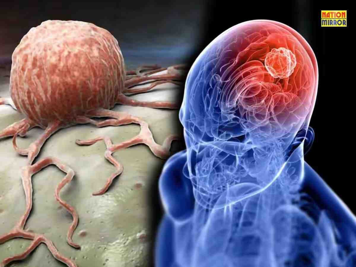 Brain Tumor SymptomsTreatment: लक्षण, कारण, अवस्थाएं और उपचार की संपूर्ण जानकारी...