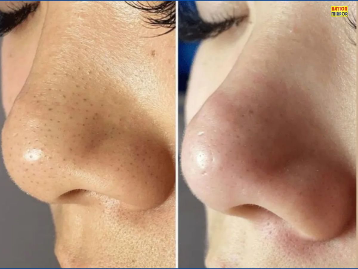 Home Remedies for Blackheads: ब्लैकहेड्स से परेशान हैं? साफ और चमकदार त्वचा के लिए अपनाएं ये घरेलु उपाय!