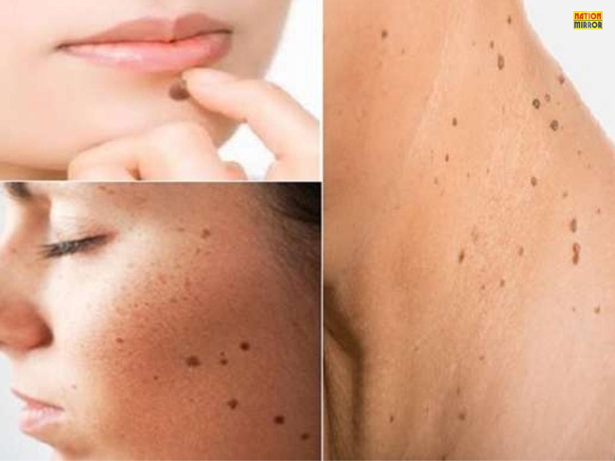 Home Remedies to Remove Moles: मुंह से तिल हटाने के असरदार घरेलू उपाय, अपनाएं ये घरेलू नुस्खे!