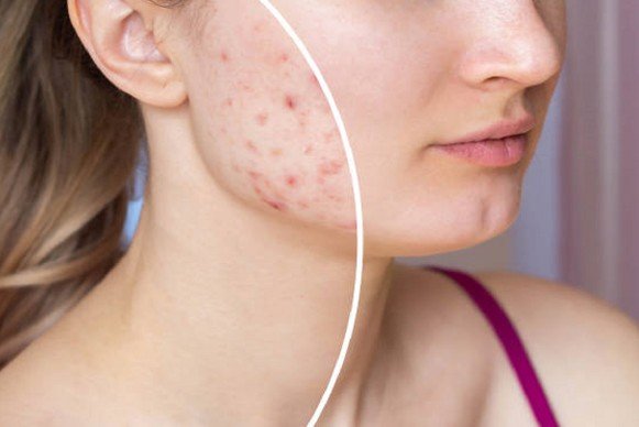 Monsoon Pimples Home Remedies: मानसून में बढ़ रहें हैं पिंपल, तो अपनाएं ये घरेलु नुस्खे...