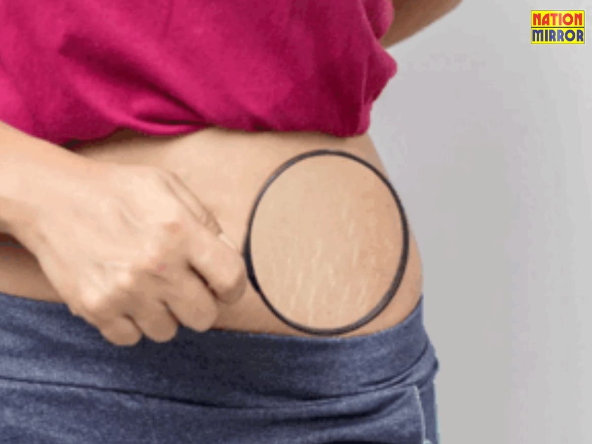 Stretch Marks Removal Tips: स्ट्रेच मार्क्स से पाना चाहते हैं छुटकारा तो कर लें अपनाएं घरेलू उपाय!