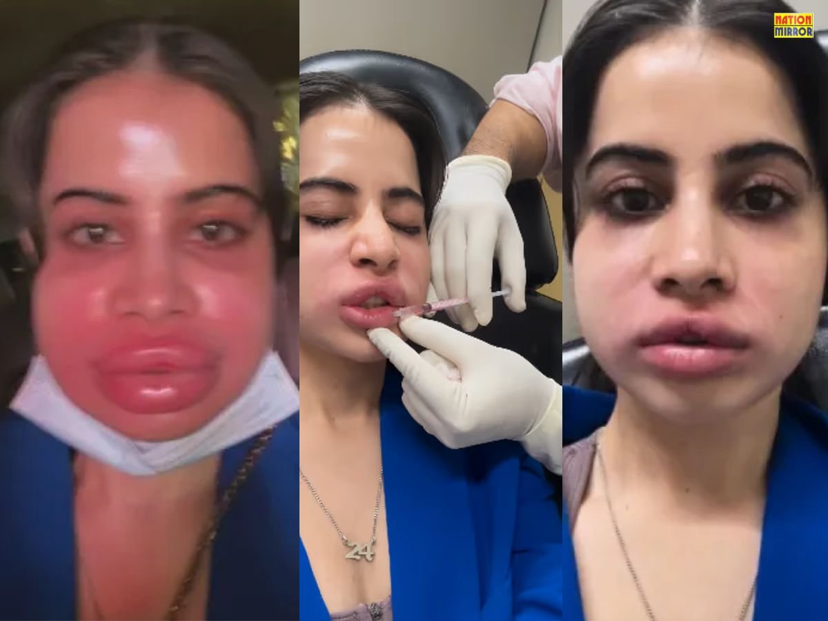 Urfi Javed Video Viral: उर्फी जावेद के सूजे होंठ देख फैंस हैरान, वीडियो हुआ वायरल...